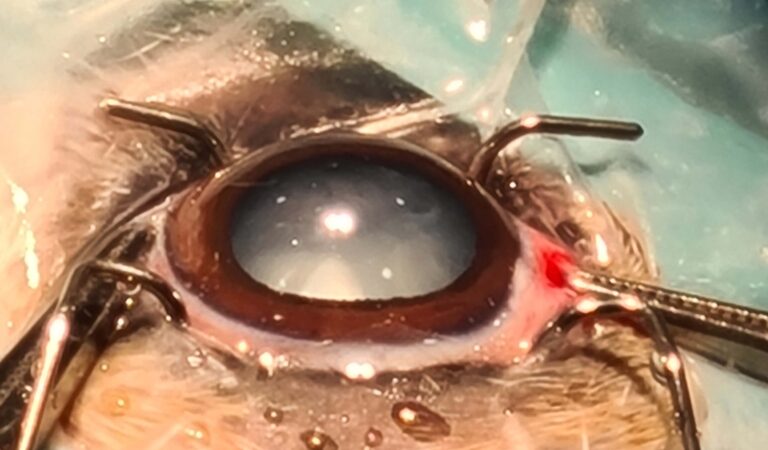 Cataract surgery